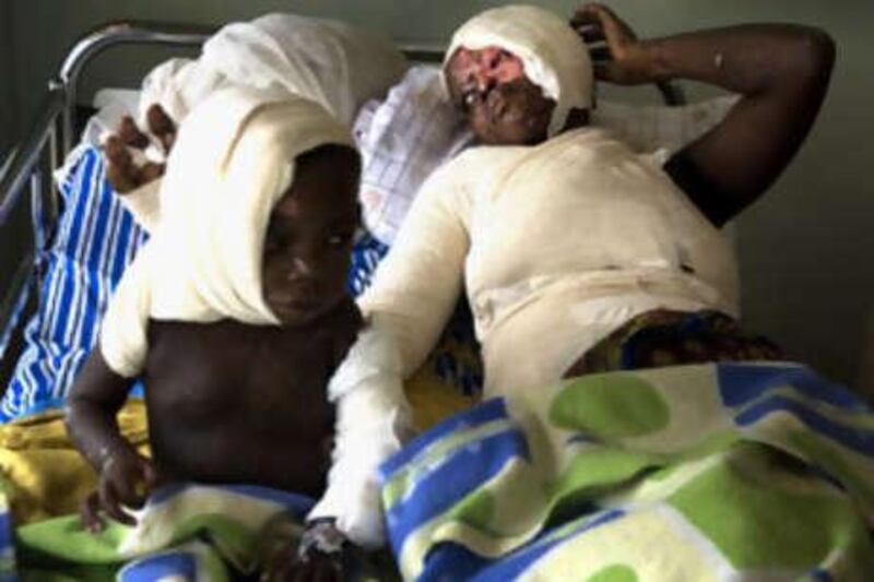 Regina Nannono and her two-year-old daughter Aleni, victims of a vicious acid attack, lie in Kampala's Mulago Hospital.