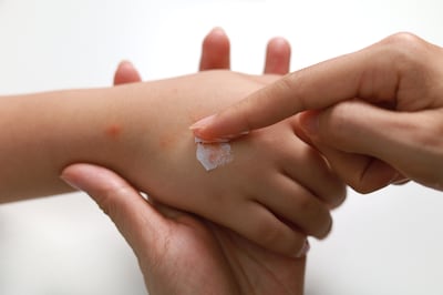 Topical creams as well as oral pharmaceuticals can treat itchy bites. Getty Images 