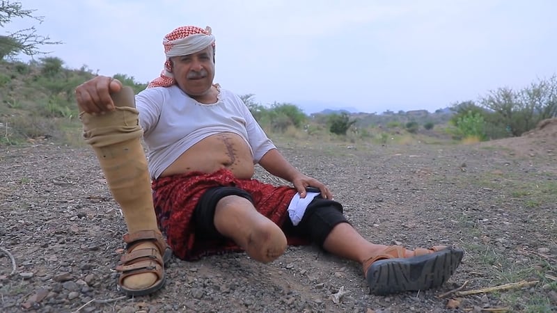 Civilians lose limbs — and their lives — all too often in Yemen, where landmines and unexploded weapons are a daily hazard after years of conflict. Photo: Masam