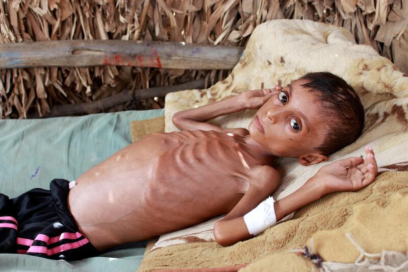 Malnourished boy Hassan Merzam Muhammad, lies on a bed at his house in Abs district of Hajjah province, Yemen. REUTERS