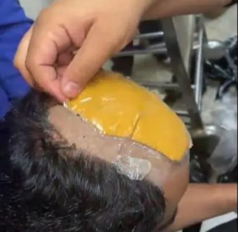 Delhi Customs released a video of an officer removing a wig from a passenger's head to reveal melted-down gold attached to his bald pate. Photo: Delhi Customs