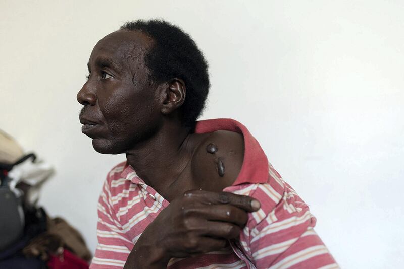 Muawia, 38-years-old originally from Darfur, Sudan, shows the scars on his shoulder, which he says are from the wounds inflicted on him when he was kidnapped for ransom by criminal groups in Libya. Muawia fled from war in his home country to Libya 10 years ago. He left his family behind. He now survives with the help of some friends and some daily jobs in Tripoli. He says that the living conditions for migrants and refugees are very dangerous, as they are continuously subjected to robbery and violence in the streets and are often kidnapped for extortion. He says he was kidnapped twice by criminal groups and during this time endured torture, including by the use of hot objects to burn his flesh.