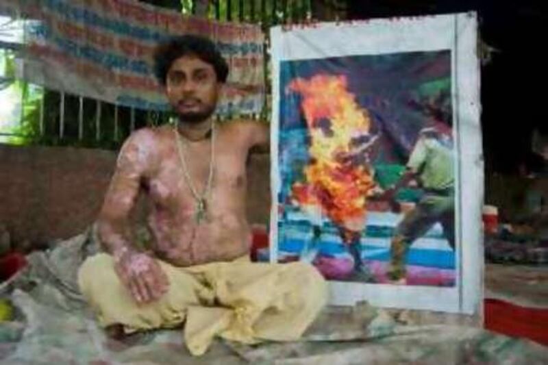 Life insurance salesman, Rajnish Kumar, (sits/stands) beneath his place under a lopsided tent at a bustling end of Jantar Mantar displaying burn scars and a photograph of himself taken on July 29, 2006 when he poured five litres of kerosene on his body and set himself on fire. Rajnish's wife and three sons went missing, his land has been seized, and police in his home state of Uttar Pradesh are unwilling to investigate his case. Rajnish is one of Jantar Mantar's longest-sitting tennants.

Credit: J. Adam Huggins for The National *** Local Caption ***  BurntProtestor3.jpg