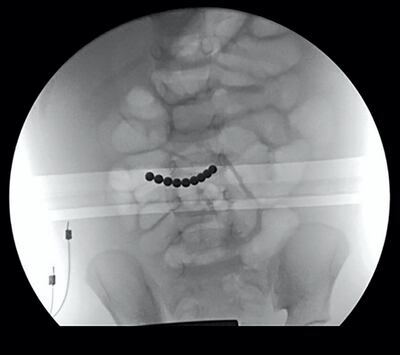 An X-ray showing magnets in the stomach of a child. If swallowed they can cause dangerous tears to the intestine wall.