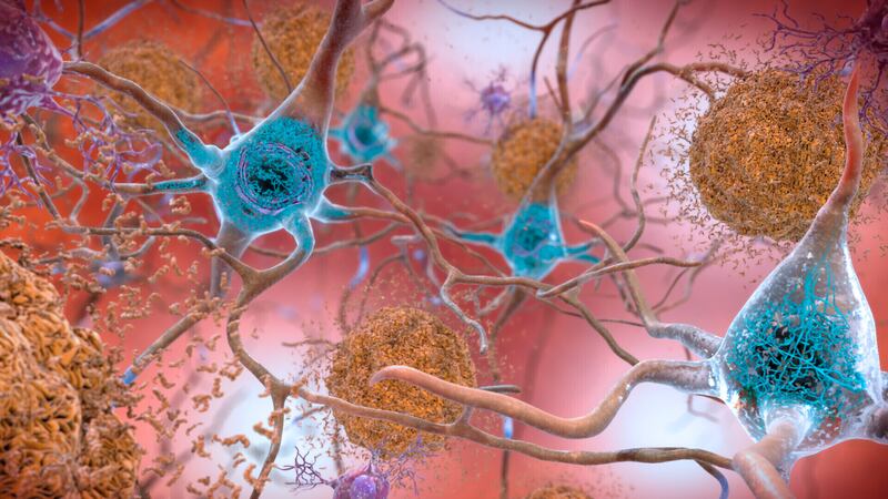 An illustration of how Alzheimer’s affects the brain, with abnormal levels of the beta-amyloid protein clumping together to form plaques – brown in this rendering – that collect between neurons and disrupt cell function. Photo: National Institute on Ageing