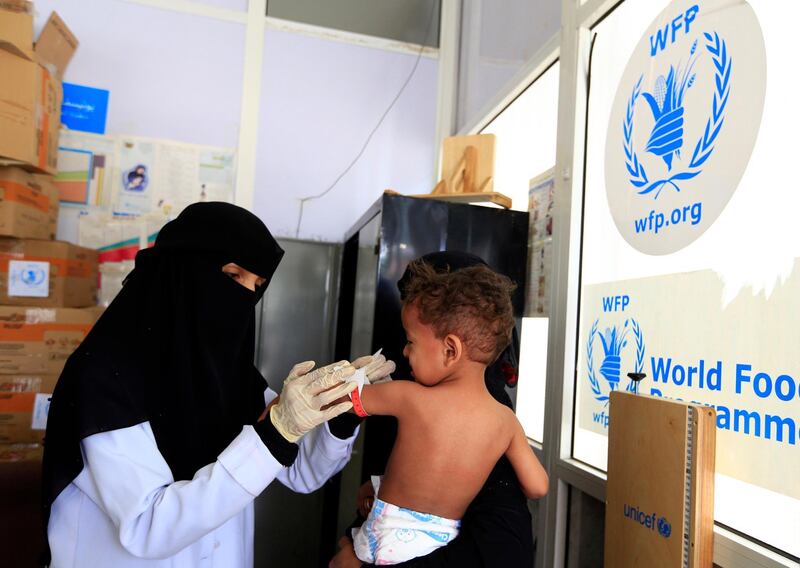 A child suffering from severe malnutrition is measured at a treatment centre in  Sanaa on June 22, 2019. AFP
