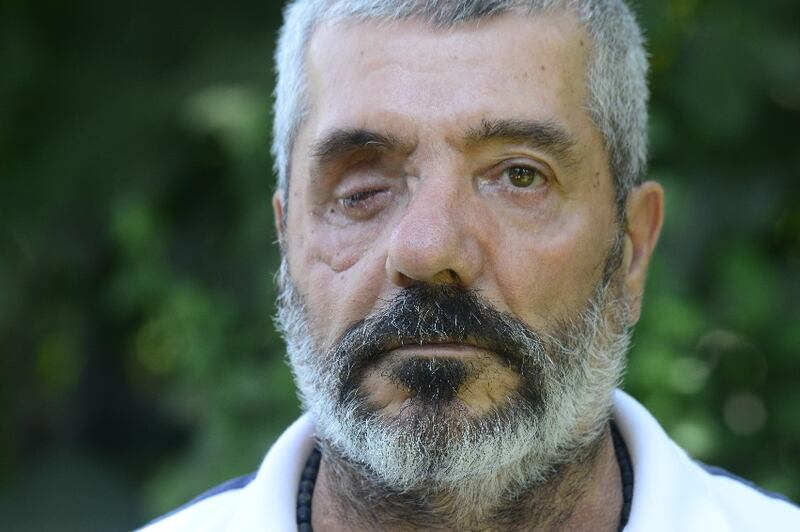 Michel Abdo, 58, lost an eye in the explosion