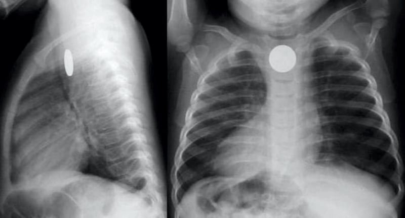 An X-ray shows a coin battery lodged in a child's respiratory tract.