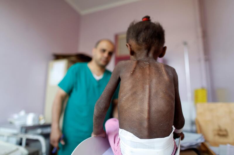 A nurse looks as he weighs a malnourished girl at a malnutrition treatment center in Sanaa, Yemen October 7, 2018. Picture taken October 7, 2018. REUTERS/Khaled Abdullah
