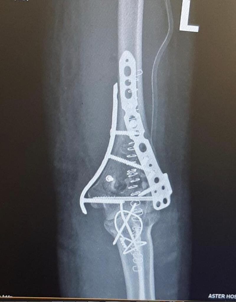 A metal pin was inserted into the elbow of nurse Pinky Cabellero who required emergency surgery to prevent her left arm being amputated. Photo: Aster Hospitals