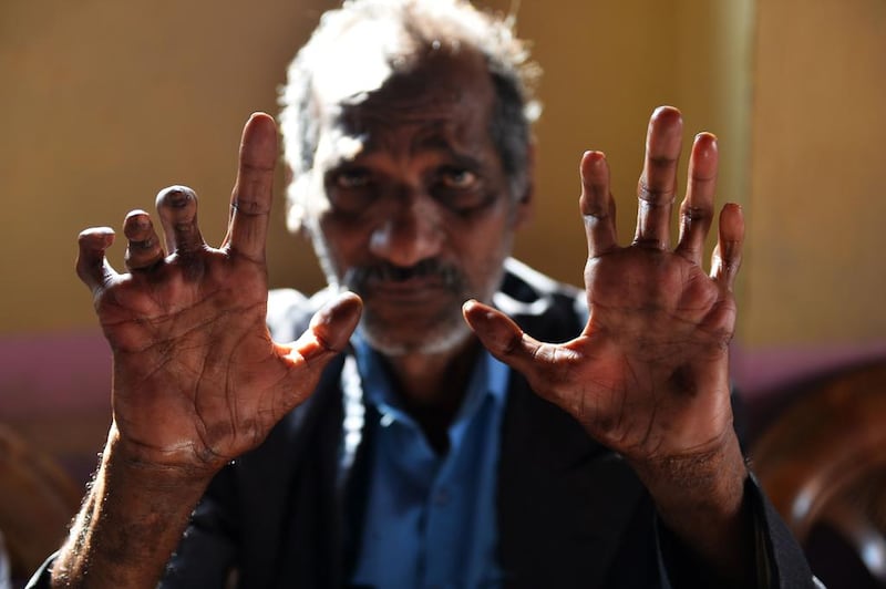Shiv Shankar Tiwari, 62, a cured leprosy patient shows his disfigured hands.