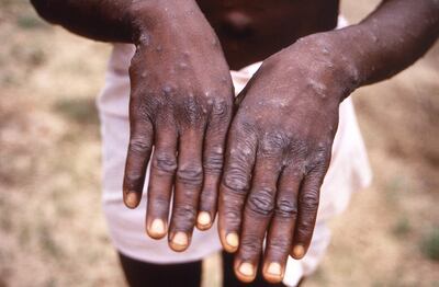 A monkeypox patient displays the appearance of the characteristic rash. AP