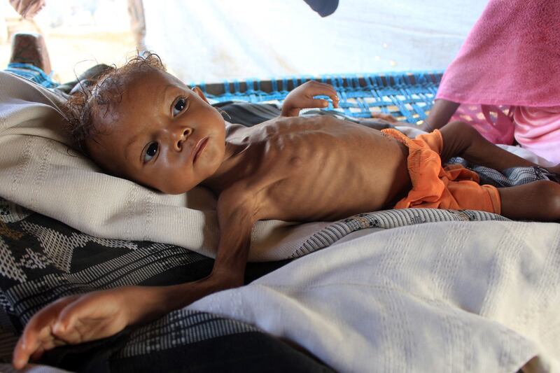 A three-year-old Yemeni child suffering from acute malnutrition. AFP