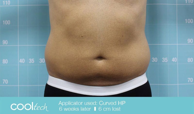Before view of a belly treated with the FDA-approved non-invasive fat-reduction procedure CoolTech, conducted at Icon Clinic in Abu Dhabi. Photo courtesy of Icon Clinic. 