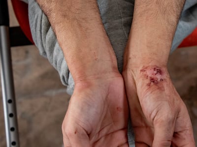 A Palestinian prisoner released by the Israeli army shows injuries to his hands sustained during his imprisonment. EPA