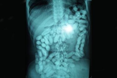 Packages of illegal drugs can be clearly seen in this X-ray of a smuggler's stomach. Courtesy: Royal Oman Police