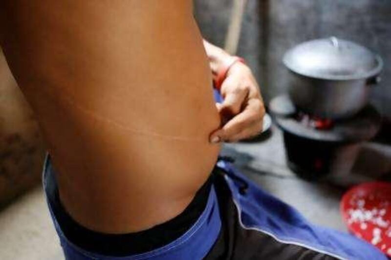 A man who sold his kidney for a transplant and who wishes to remain unidentified, shows his scar while cooking at his home in a slum area at Tondo, Metro Manila April 29, 2008. The Philippines has banned the sale of organs to foreigners because of a surge in illegal trade of kidneys and other organs taken from the poor, health secretary Francisco Duque said on Tuesday. REUTERS/Romeo Ranoco  (PHILIPPINES)