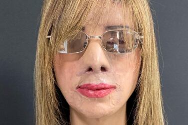 Heba Hosni, who was the victim of an acid attack in 2008, returned to Egypt after eight operations in two years in Dubai to reconstruct her face. Courtesy: Dr Mohan Rangaswamy