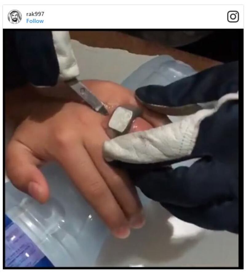 RAK Civil Defence have released a video of an operation to free a boy's ring finger from a large nut