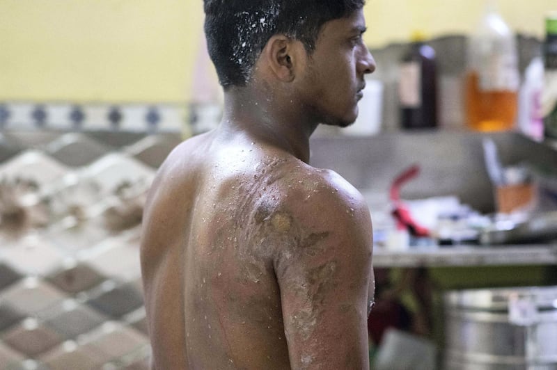 Rohit Lohia: Rehman, a 21year old. Son of Rizwan was attacked with acid on 24/02/2020 in Shiv Vihar area when Right wing hindu militants attacked the area and victimised many members of muslim community protesting against new citizenship amendment act in nation. Rehman, a worker in bakery shop was working when a mob chased him and was met with an acid bottle which was thrown at him. He tells mob continued chanting ‚ÄòJai shree ram‚Äô while attacking.