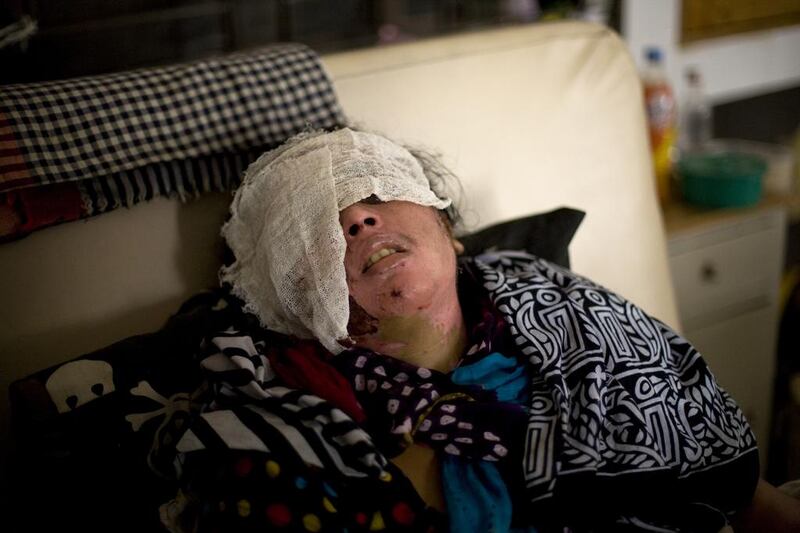 Lucky Akthar, a Bangladeshi woman, was attacked with acid as she used the toilet outside her home (Photo: Sanjit Das for The National)