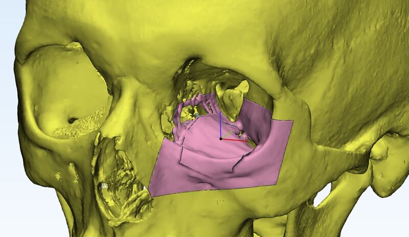 Surgeons in Umm Al Quwain designed a 3D-printed model of a patient's left eye socket by reconstructing a metal mesh to treat multiple fractures. Supplied