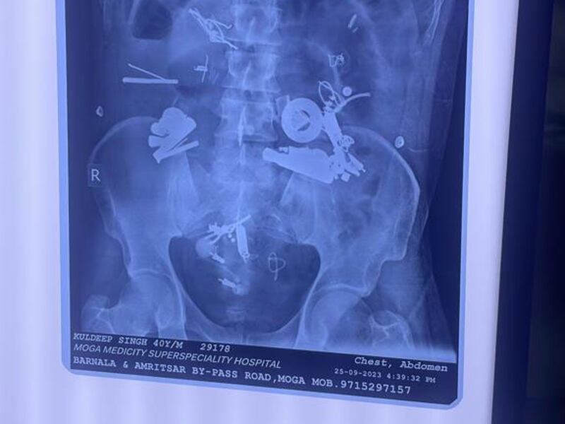 An X-ray showing 150 foreign objects in a man's stomach at Medicity Hospital in Moga, Punjab, India. Ajemr Kalra / Moga Hospital