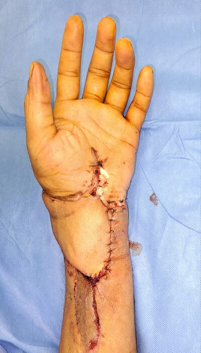 After 10 hours of surgery, Pyae Phyo Aung, 37, had his hand successfully reattached. Photo: NMC Royal Hospital