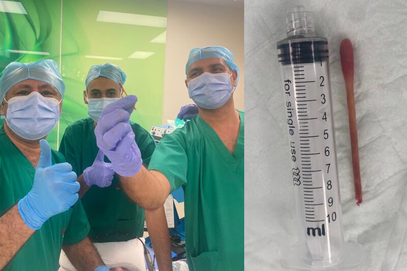 Doctor saves life of a 80-year-old Emirati; Removes 10-cm long cotton bud stick from trachea. Handout