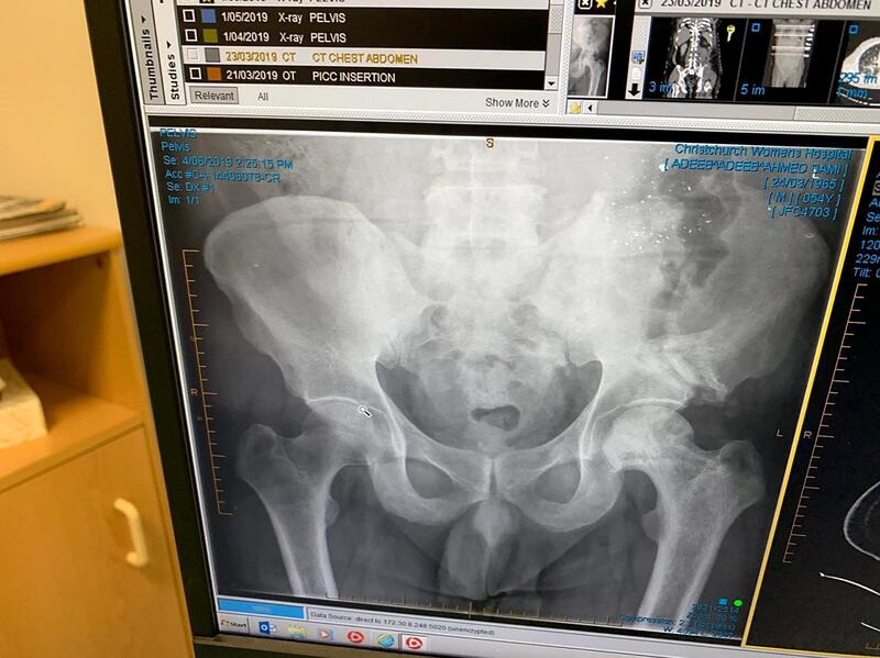 An x-ray from June 4 showing the bullet fragments in Sami’s hip, and the fracture of his hip bone. Courtesy Adeeb Sami.