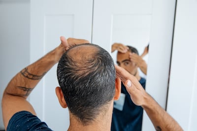 The psychological implications of male hair loss can vary greatly from person to person. Getty Images