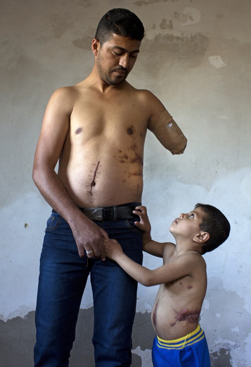 Nabil Siyam,34, who lost his arm and sustained other injuries stands with his son Badruddin, 5 at their home in Rafa, Gaza December 29,2014 . Nabil and his son were injured when an Israeli bomb exploded outside there home on July 21 during  last summer’s war . The explosion killed Nabil’s wife Shireen and 4 of his children . The attack also claimed the lives of his two brother’s and their wives and three of their children who were all staying at the house . Badruddin lost a kidney . Heidi Levine for The National