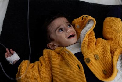 A Palestinian boy suffering from malnutrition is attended to at a healthcare centre in Rafah on March 4. Reuters