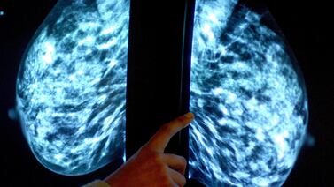 Early intervention with immunotherapy drugs in healthy women carrying cancer causing genes could prove an effective preventive measure against breast cancer. Rui Vieira / PA Wire