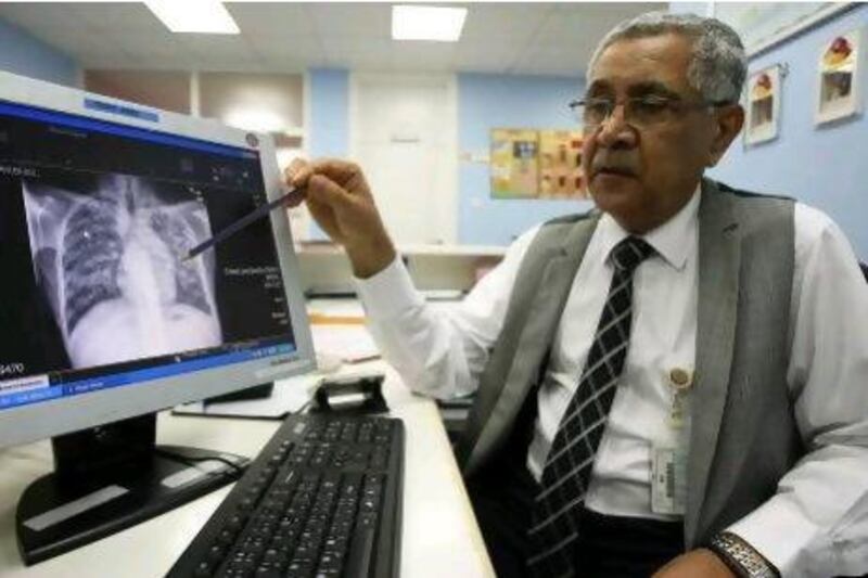 Dr . Mirza Al Sayegh, a consultant physician at the Dubai Health Authority, points out lung scarring from tuberculosis on a chest X-ray.