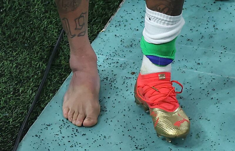 The swollen ankle of Brazil forward Neymar, taken as he leaves the field at the end of the Qatar 2022 World Cup Group G football match between Brazil and Serbia. AFP