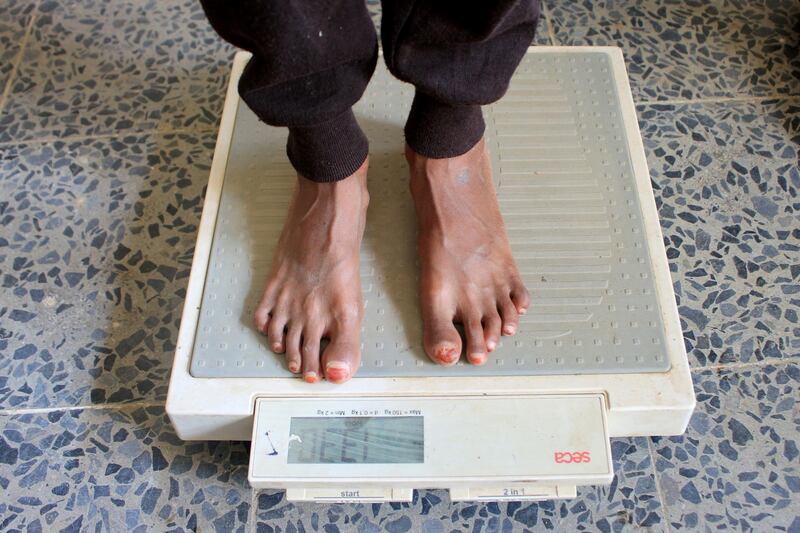 Malnourished boy Hassan Merzam Muhammad stands on a weight scale at a medical center in Abs district of Hajjah province, November 24. Reuters