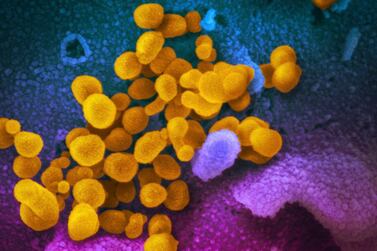 A microscope image of the Novel Coronavirus SARS-CoV-2 (yellow) emerging from the surface of cells (blue/pink) cultured in a lab. AP