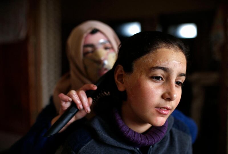 Palestinian Izdihar al-Amawi combs her daughter Maram's hair at home in Gaza City, on February 28, 2021. Severely burned a year ago in an inferno caused by a gas leak, authorities said, in the Palestinian refugee camp of Nuseirat in the central Gaza Strip, Maram and her mother Intizar wear transparent 3D-printed plastic masks developed by the Doctors Without Borders (Medecins Sans frontieres - MSF) international healthcare charity, which put pressure on the face and advance the healing process, the NGO representative in Gaza said. / AFP / MOHAMMED ABED

