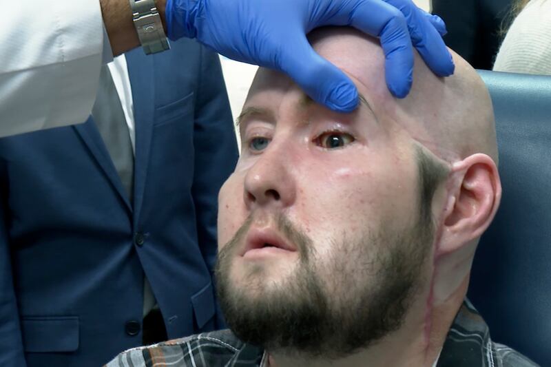 Surgeons in New York have reconstructed Aaron James's face and hope sight can be restored to the transplanted left eye. AP