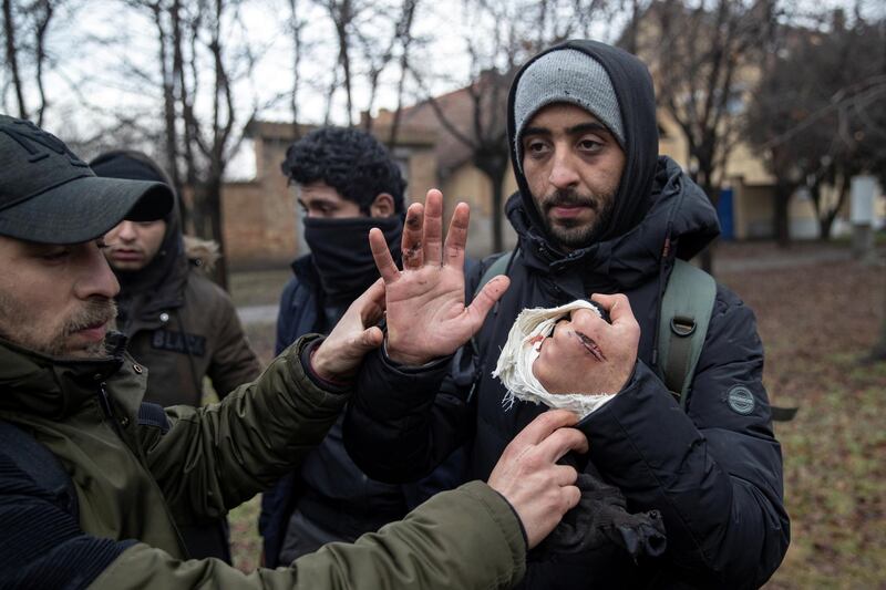 An injured migrant shows the wounds that he says are caused by Hungarian police in Horgos, Serbia, January 28, 2020. REUTERS/Marko Djurica