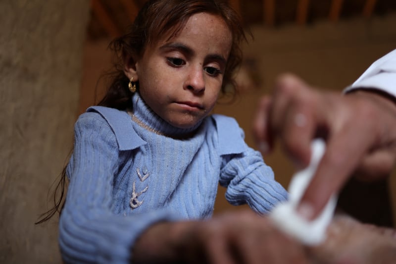 Kazem Hussain, 52, applies ointment to the hands of his niece, Zahraa Ali Hassan, 7, to treat a skin problem the family says is caused by contaminated water, in Al Bu Ruwayyshid village, Diwaniya, Iraq.  Zahraa's family say that others suffer with the same skin problems and many have diarrhoea due to the water supply