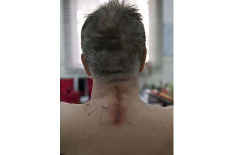 A view of the scar on the back of Trevor Stott-Briggs' neck following surgery.