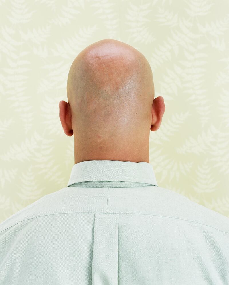 Bald man, close-up, rear view. Getty Images