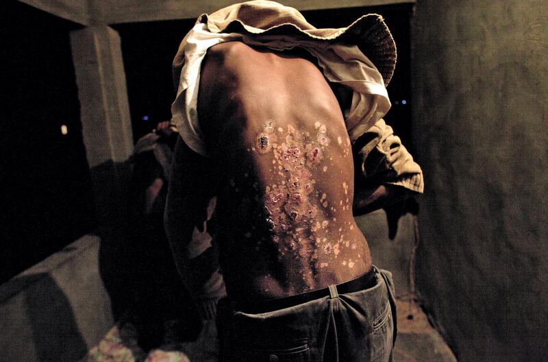 An African asylum seeker from Eritrea  shows the scars on his back he says were caused by burning plastic being dripped over him by his Beduin captor  at a labor camp in the  Sinai Peninsula .The man who wishes to keep his identity hidden managed to escape with some others who suffered the same torture and are being held in a house until they are given permission to go to Cairo by the UNHCR .(Photo by Heidi Levine/Sipa Press)./Credit:LEVINE/SIPA/1207041159