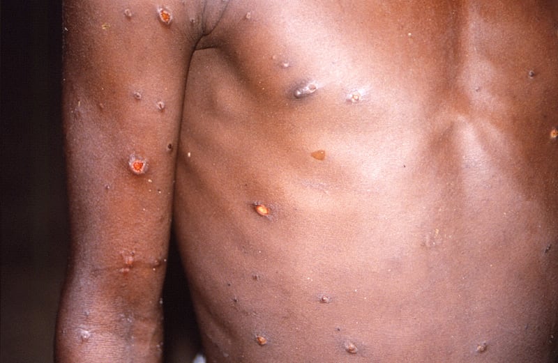 An image taken during an outbreak of monkeypox in the Democratic Republic of the Congo in 1996 and 1997 shows the arms and torso of a patient with skin lesions due to monkeypox. Reuters