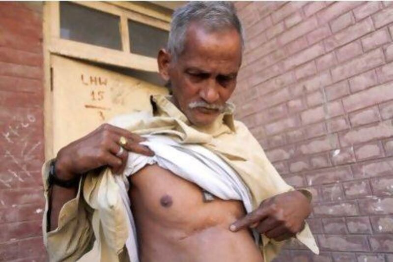 Abul Hasan, a former soldier, shows his scars while fighting alongside Pakistan troops in the 1971 war.