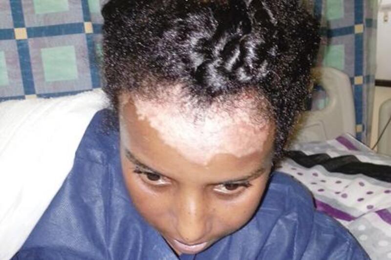 March 24, 2013 - An Ethiopian maid, identified as B.K 23 
who is in Al Qassimi hospital due to burns. Police in Sharjah  are investigating a Moroccan woman accused of torturing her.

Courtesy Al Itiihad 