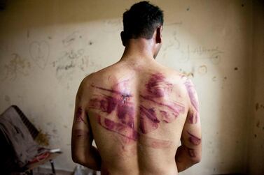 A Syrian man shows marks of torture on his back after he was released by regime forces in Aleppo. AFP 