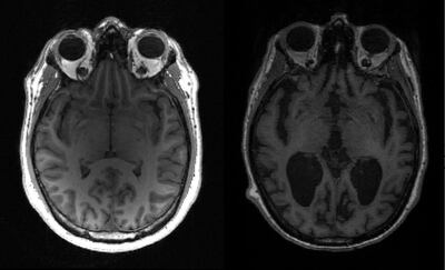 Alzheimer’s causes about two thirds of cases of dementia in over-65s and affects more than 44 million people worldwide. AFP